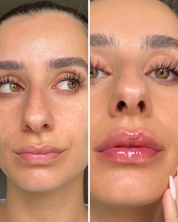 Lip Volume Extrême