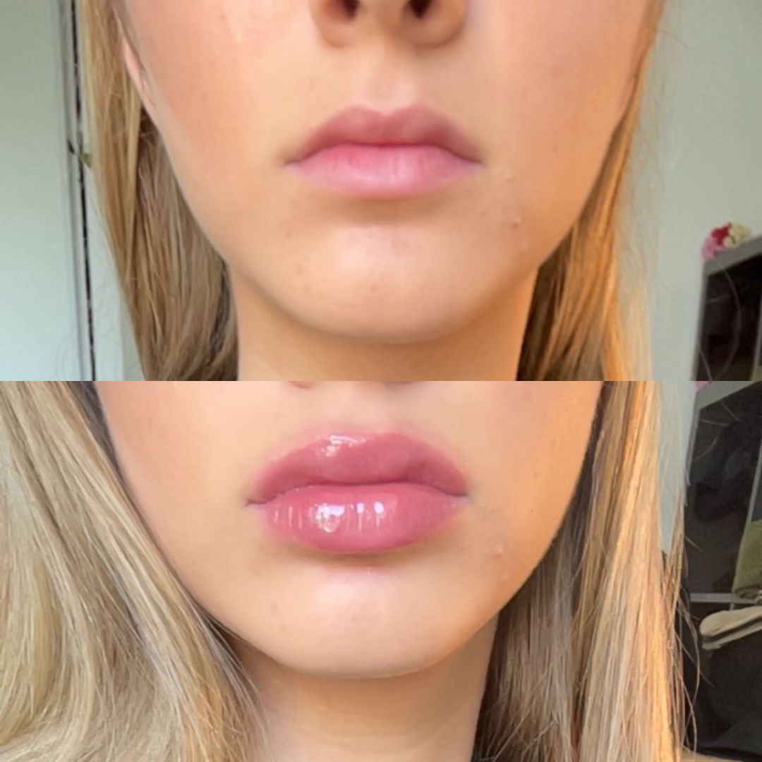 Victoria - Lip Volume