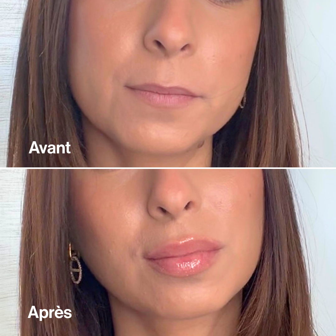 Avanr-ApresLipVolume.png